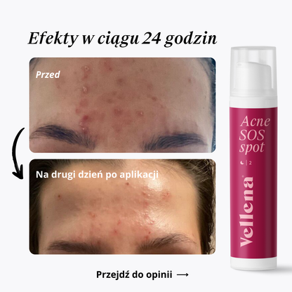 Żel na wypryski 15ml | Vellena